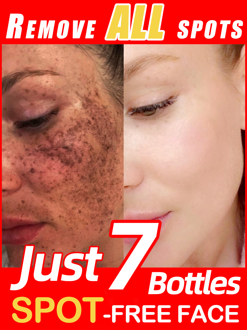 Lighten Freckles Melasma, Faci - đánh giá và giá Luxury Natural Skincare